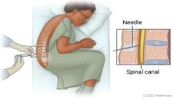 anatomic landmarks in safe lumbar puncture